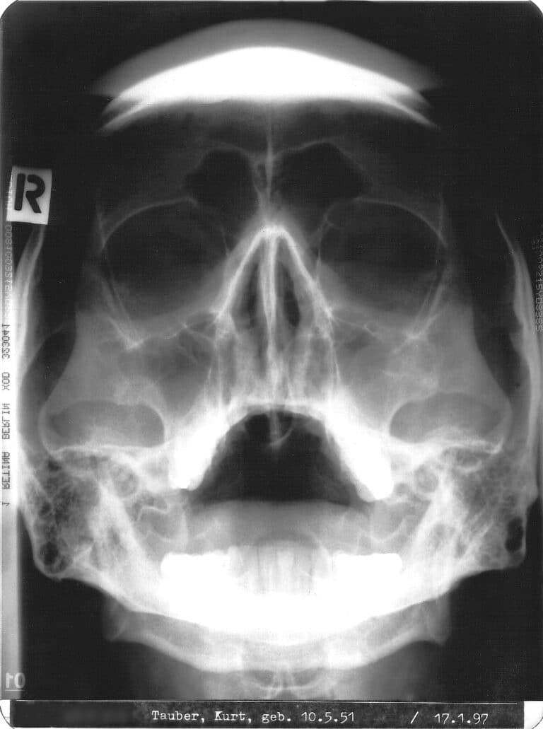 roentgenbild tauber